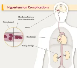 Hypertension Complications via CDC (www.cdc.gov).